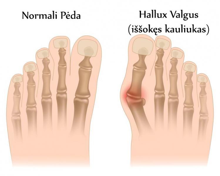 Lively Stem imply Ortopedijos sprendimai - 5 Faktai ir Mitai apie iššokusį pėdos kauliuką - Hallux  Valgus